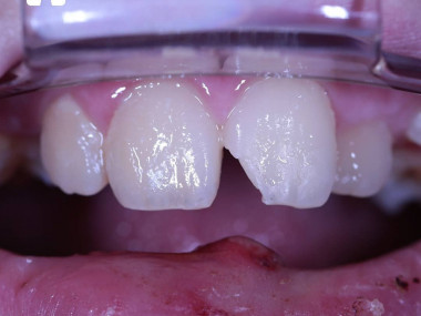 Перелом коронки зуба